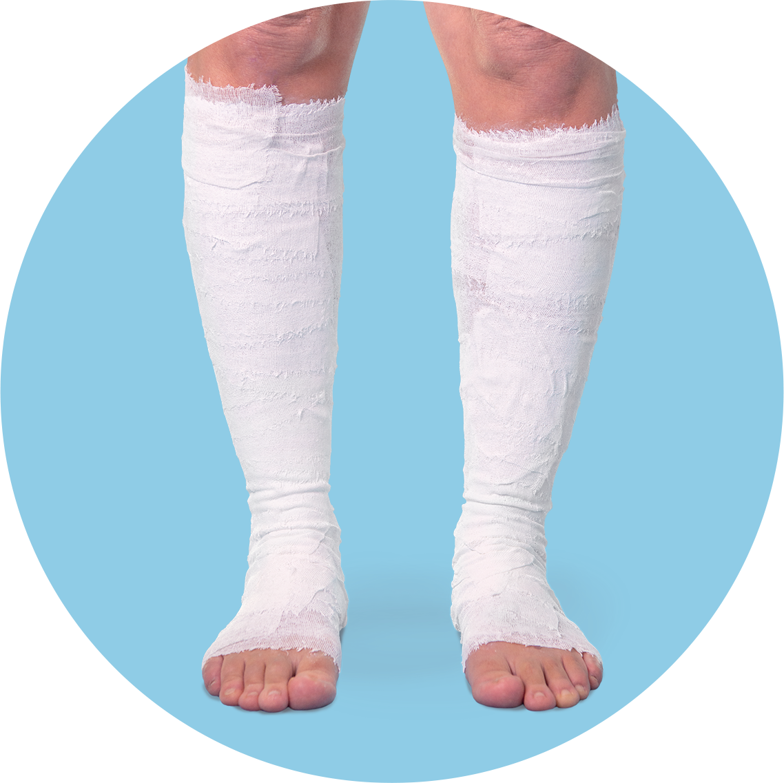 Visco Legs Blue Circle Viscopaste bandage applied to lower limbs.